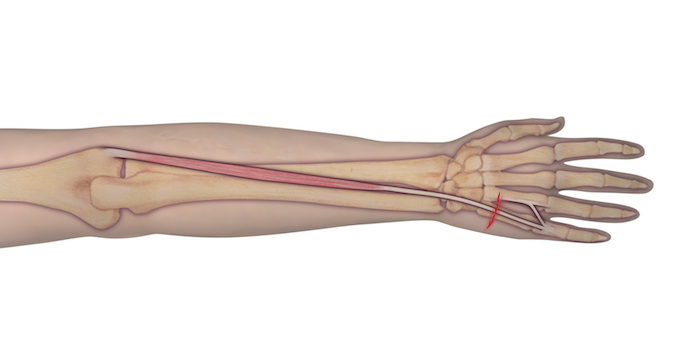 This illustration represents the anatomy of the muscle and tendon origin and insertion. Should an individual sustain a laceration as depicted, the observer can assume that the underlying tendon may be at risk for complete transection. A proper examination is needed to determine the integrity of the tendon.