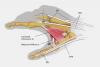 The extensor indicis (EIP) transfer to improve thumb abduction starts with an incision over the index MP joint and the ulnar aspect of the metacarpal neck.  The EIP is released from the extensor hood over the base of the index proximal phalanx. The defect at (1) is repaired. The EIP is passed subcutaneously and under the long EDC. Next a clamp is used to pass it through the III-IV metacarpal interspace and into the palm. The tendon and clamp are identified ulnar to the long metacarpal and flexor tendon shea