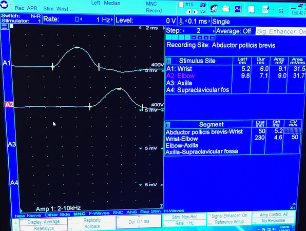 Electrophysiological testing findings consistent with Carpal Tunnel Syndrome.