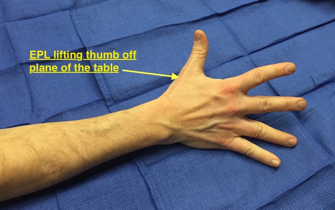 EPL Muscle Testing. Note thumb raised off plane of table.