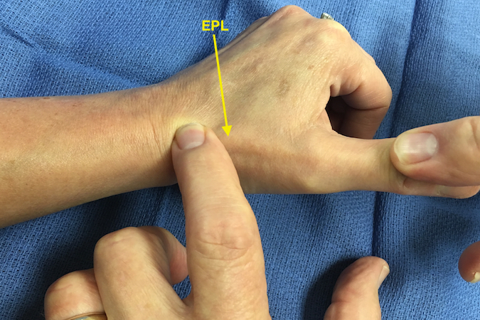 Extensor Tendon Exam | Hand Surgery Resource