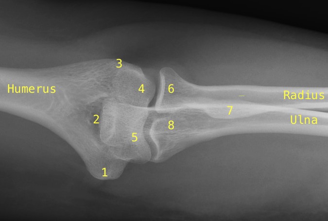 Elbow AP: 1-Medial Epicondyle; 2-Coronoid Fossa; 3-Lateral Epicondyle; 4-Capitellum; 5- Trochlea; 6- Radial Head; 7-Radial Tuberosity; 8- Coronoid