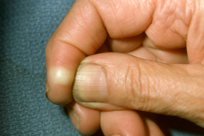 EPIDERMOID CYST | Hand Surgery Resource