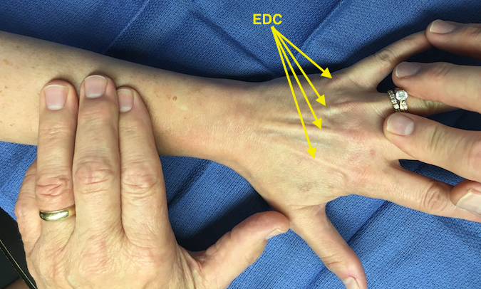 Extensor digitorum communis (EDC) extending MP joints against resistance