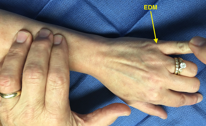 Extensor digiti minimi (EDM) extending little finger MP while long and ring held in flexion.