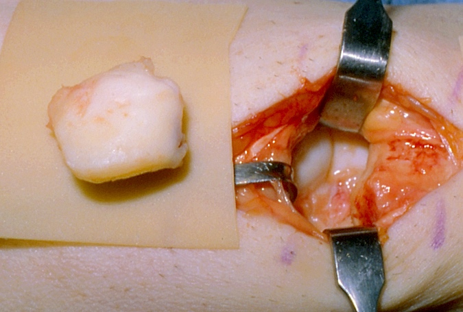 Kienbock's Disease (AVN of Lunate) Necrotic painful lunate excised