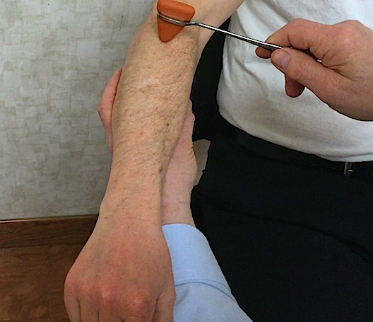 Brachioradialis (Extensor) Reflex (C6) at right elbow.