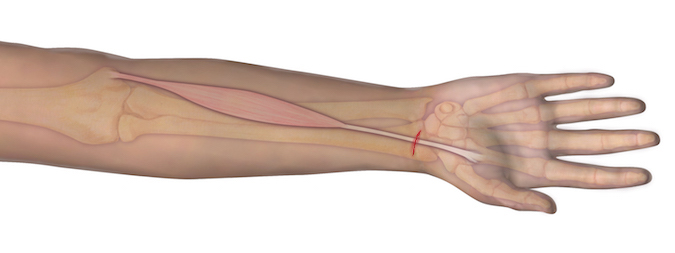 This illustration represents the anatomy of the muscle and tendon origin and insertion. Should an individual sustain a laceration as depicted, the observer can assume that the underlying tendon may be at risk for complete transection. A proper examination is needed to determine the integrity of the tendon.