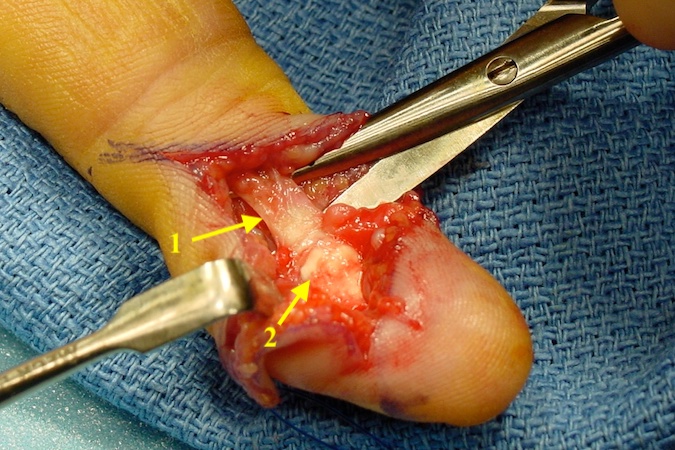 FDP stump with hypertrophic tenosynovium (1) and volar plate (2)