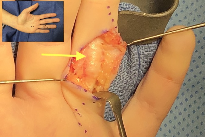 Note swollen flexor tendon sheath at PIP joint (arrow) secondary to avulsed (ruptured) left ring FDP in female rugby player.