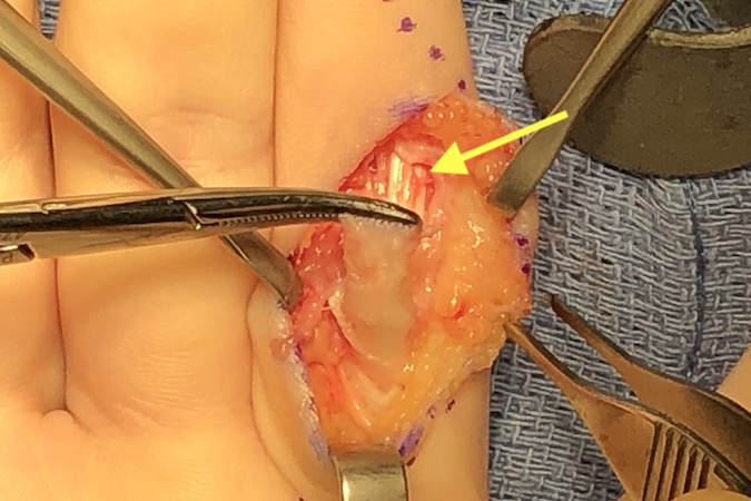 Curciate pulley opened and FDP stump (in clamp) dissected free. Intact FDS at arrow.