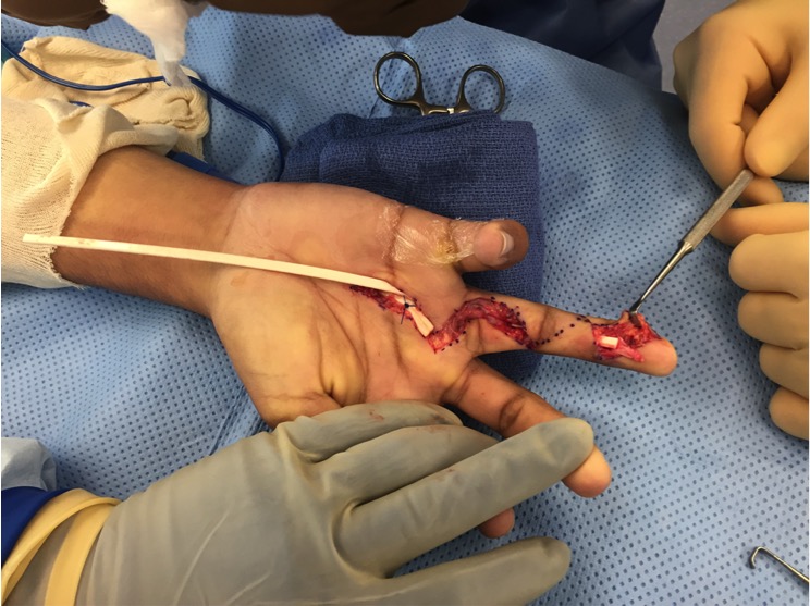 Hunter rod passed through flexor sheath