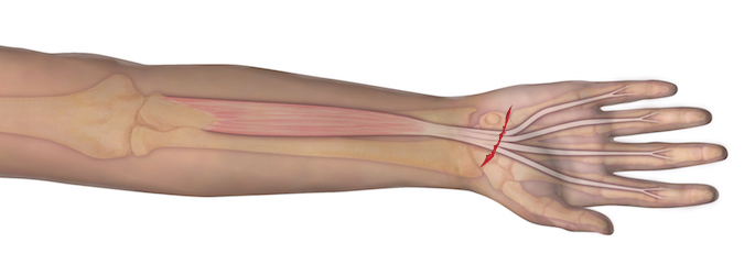 This illustration represents the anatomy of the muscle and tendon origin and insertion. Should an individual sustain a laceration as depicted, the observer can assume that the underlying tendon may be at risk for complete transection. A proper examination is needed to determine the integrity of the tendon.