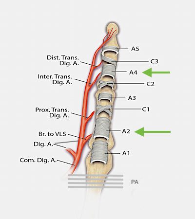 This diagram highlights the vascular supply and components of the flexor tendon sheath. The three cruciate pulleys (C1-3), the five annular pulleys (A1-A5) and the palmar aponeurotic pulley (PA) are shown. The A2 and A4 pulleys are the biomechanically the most important pulleys. During flexor tendon surgery, Tang(ref14) has shown that the A2 pulley can be 50% excised or vented and the A4 can be 100% vented if needed for tendon excursion if the other parts of the sheath are intact