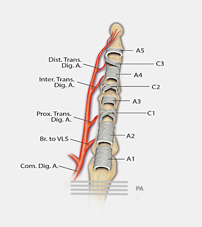 This diagram highlights the vascular supply and components of the flexor tendon sheath.  The three  cruciate pulleys (C1-3), the five annular pulleys (A1-A5) and the palmar aponeurotic pulley (PA) are shown.  The A2 and A4 pulleys are the biomechanically the most important pulleys.  During flexor tendon surgery, Tang(ref14) has shown that the A2 pulley can be 50% excised or vented and the A4 can be 100% vented if needed for tendon excursion if the other parts of the sheath are intact