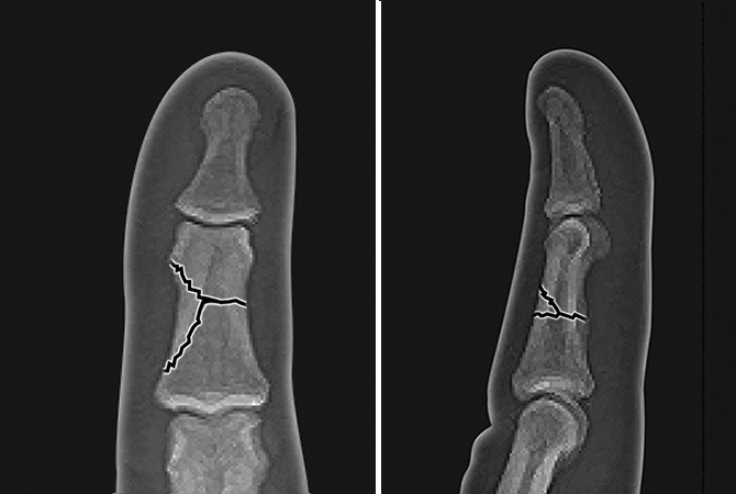 Non-displaced middle phalanx shaft fracture