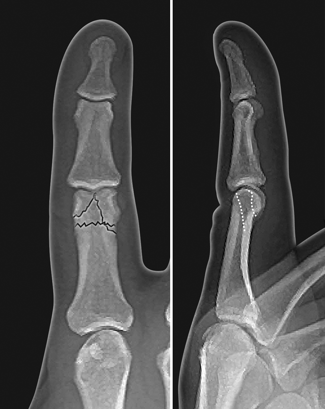 Comminuted intra-articular proximal phalanx neck and head fracture