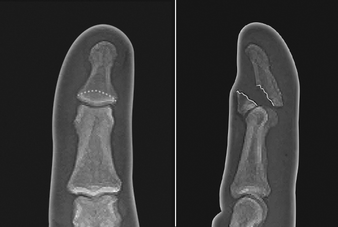 Markedly displaced mallet fracture of the distal phalanx that requires reduction and pinning