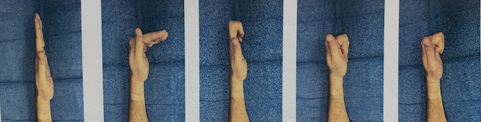 Do active tendon gliding exercises, beginning with fingers straight & ending with full fist. Do each 10x, holding position 2 seconds. You may use other hand to stretch your involved fingers.  Stretch in each position for 10 seconds each, 5 reps of each.