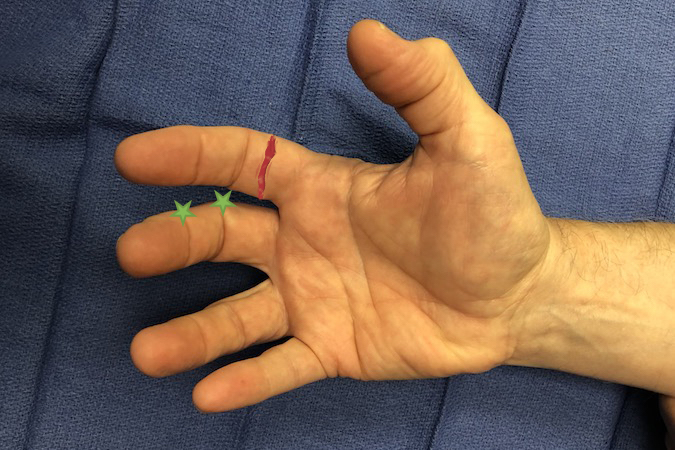 Palmar laceration over mid-third of the index proximal phalanx. Structures at Risk: 1. Skin; 2.Tendons - FDP&FDFS; 3. Digital Nerves; 4. Digital Arteries; 5. Bone; 6. Possibly PIP Joint; 7. Distal edge of A-2 Pulley. Note green stars at dorsal end of flexion creases.  The neurovascular bundle is immediately volar to these stars. (Click on structure to see exam)