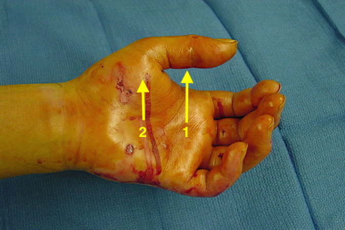 THENAR ABSCESS (INFECTION, THENAR SPACE) | Hand Surgery Resource