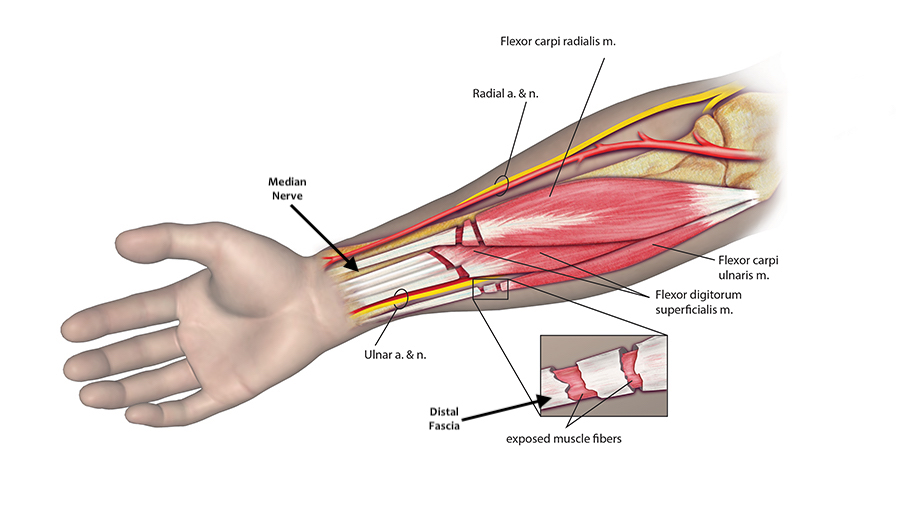 Fractional tendon lengthening:  In the drawing note the neurovascular structures, the transvers incisions in the superficial musculotendinous units and the intact distal fascia just proximal to the tendons.  An alternative to fractional lengthening is Z-lengthening of the tendons.