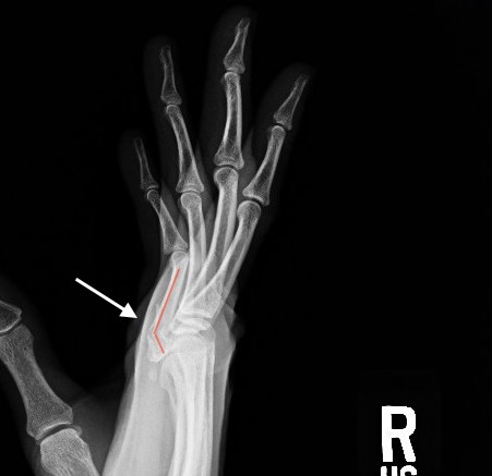 Proximal phalanx angulated base fracture lateral