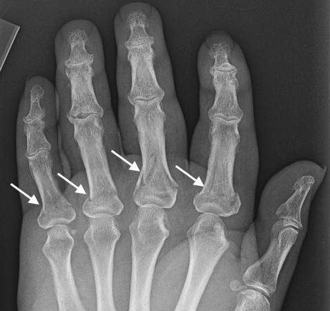 FINGER PROXIMAL PHALANX FRACTURE ADULT | Hand Surgery Resource