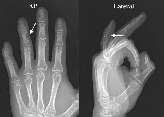 Healed open middle phalanx shaft fracture