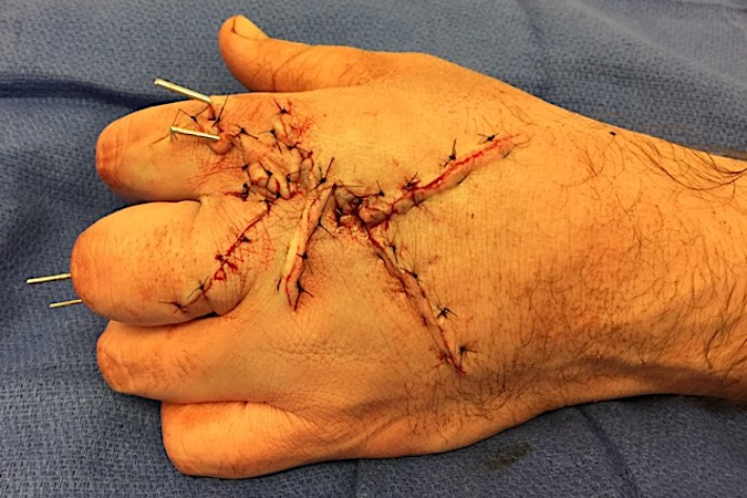 Dorsal wound closure after irrigation, debridement, soft tissue repair and ORIF of multiple fractures