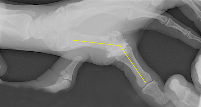 Thumb MP stress X-ray consistent with ulnar collateral ligament rupture. X-ray done after arthrogram.