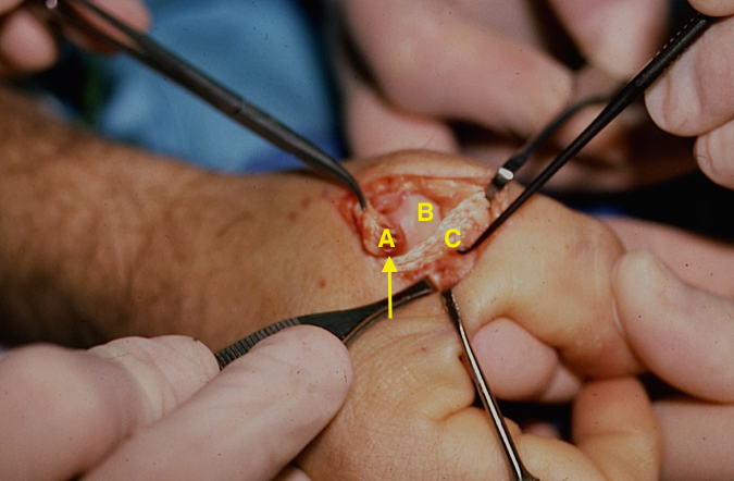 Stener's lesion - A=dorsally and proximally displaced ulnar collateral ligament; B=thumb metacarpal head; C= adductor aponeurosis and arrow indicates where aponeurosis catches on base of the displaces collateral and blocks it from its intra-articular insertion on the proximal phalanx.