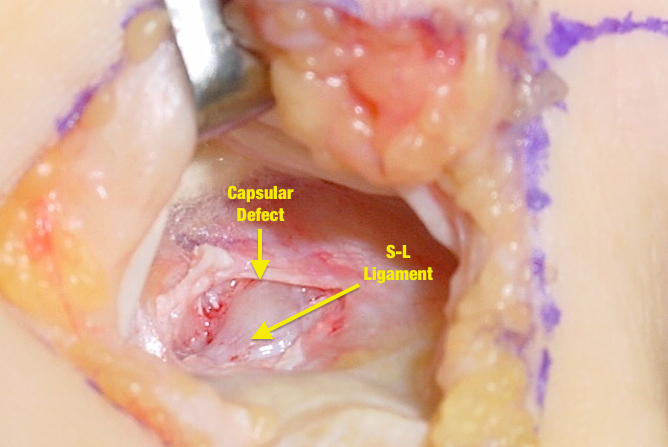 Dorsal Capsule after ganglion excision with extensor tendons retracted.