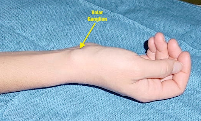 Volar Carpal Ganglion