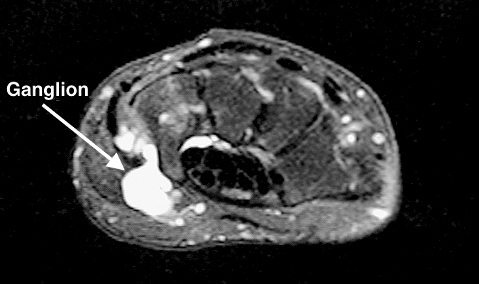 MRI showing ganglion in Guyon's canal