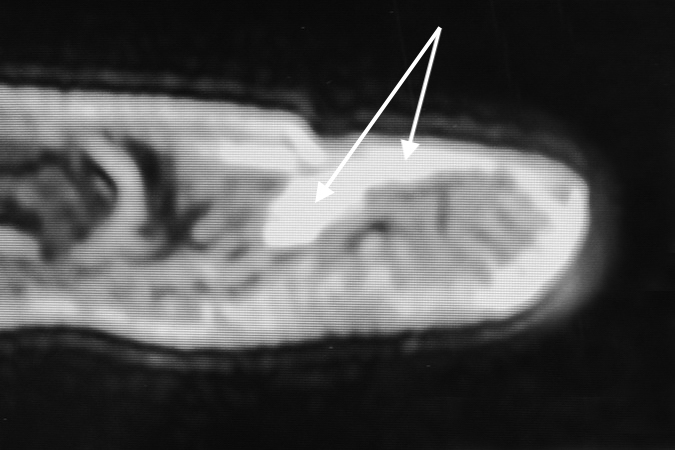 Imaging Studies for Glomus Tumor