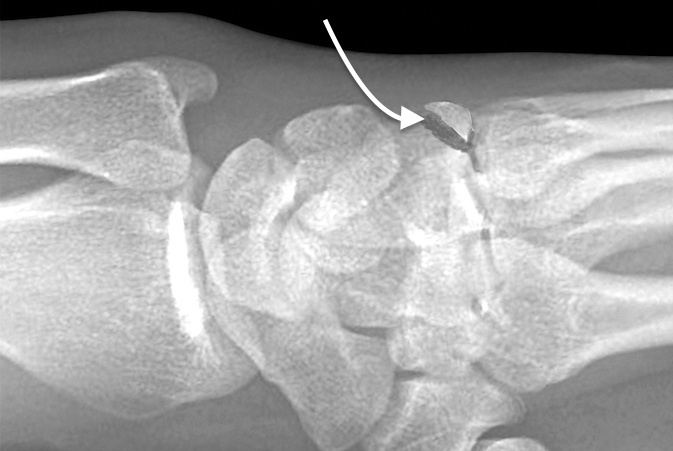 Hamate Dorsal Lip Fracture (curved arrow) displaced