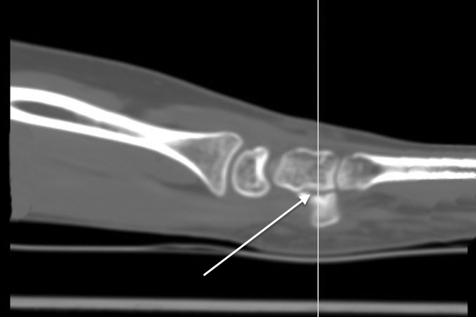 HAMATE & HOOK OF HAMATE FRACTURES | Hand Surgery Resource