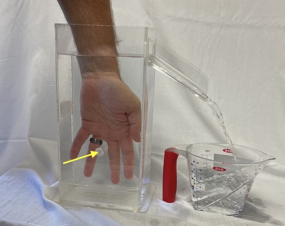 The hand volume is an excellent method for documenting hand edema.  The volume of the displaced water shows the volume of the hand. The peg (arrow) standardizes the hand position in the tank.