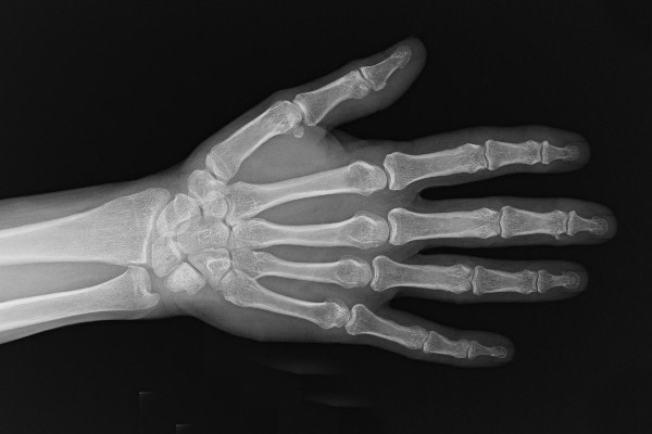 Right Hand AP view - phalanges and metacarpals.  Carpal bones, radius and ulna also visible.