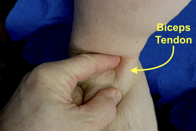 The hook Test was originally described by Driscoll. The patient holds the elbow in 90 degrees of flexion and full supination. The examiner’s index finger is inserted from lateral to medial at the antecubital fossa’s flexion crease. If the biceps is intact the examining finger can go behind the palpable biceps tendon and pull against it. If the tendon was ruptured, the examining finger would just push against the skin and subcutaneous tissues.