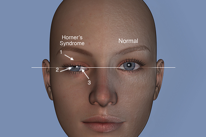 Horner's Sign | Hand Surgery Resource