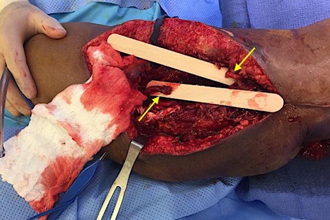 Radial nerve ends (arrows) at secondary nerve grafting procedure,  Original injury cut the radial nerve and damaged a significant length of the radial nerve creating a true nerve gap.