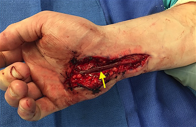 Vein graft used to replace ulnar artery thrombosis [arrow].