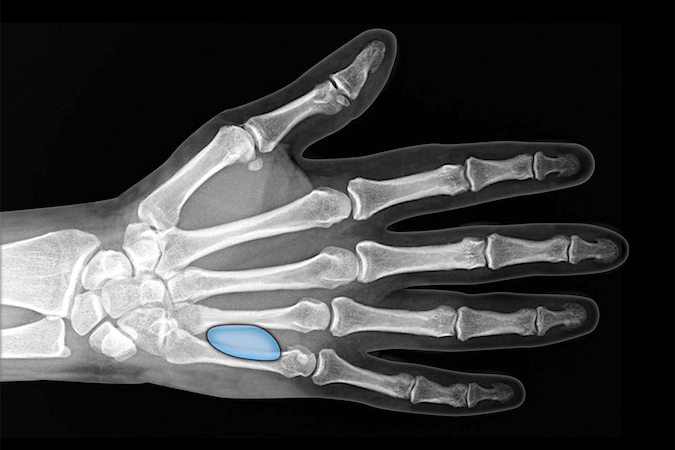 The hypothenar space is a potential space between the combined palmar and superficial hypothenar muscle fascia and the deep hypothenar muscle fascia.  Infection is usually secondary to a puncture wound.