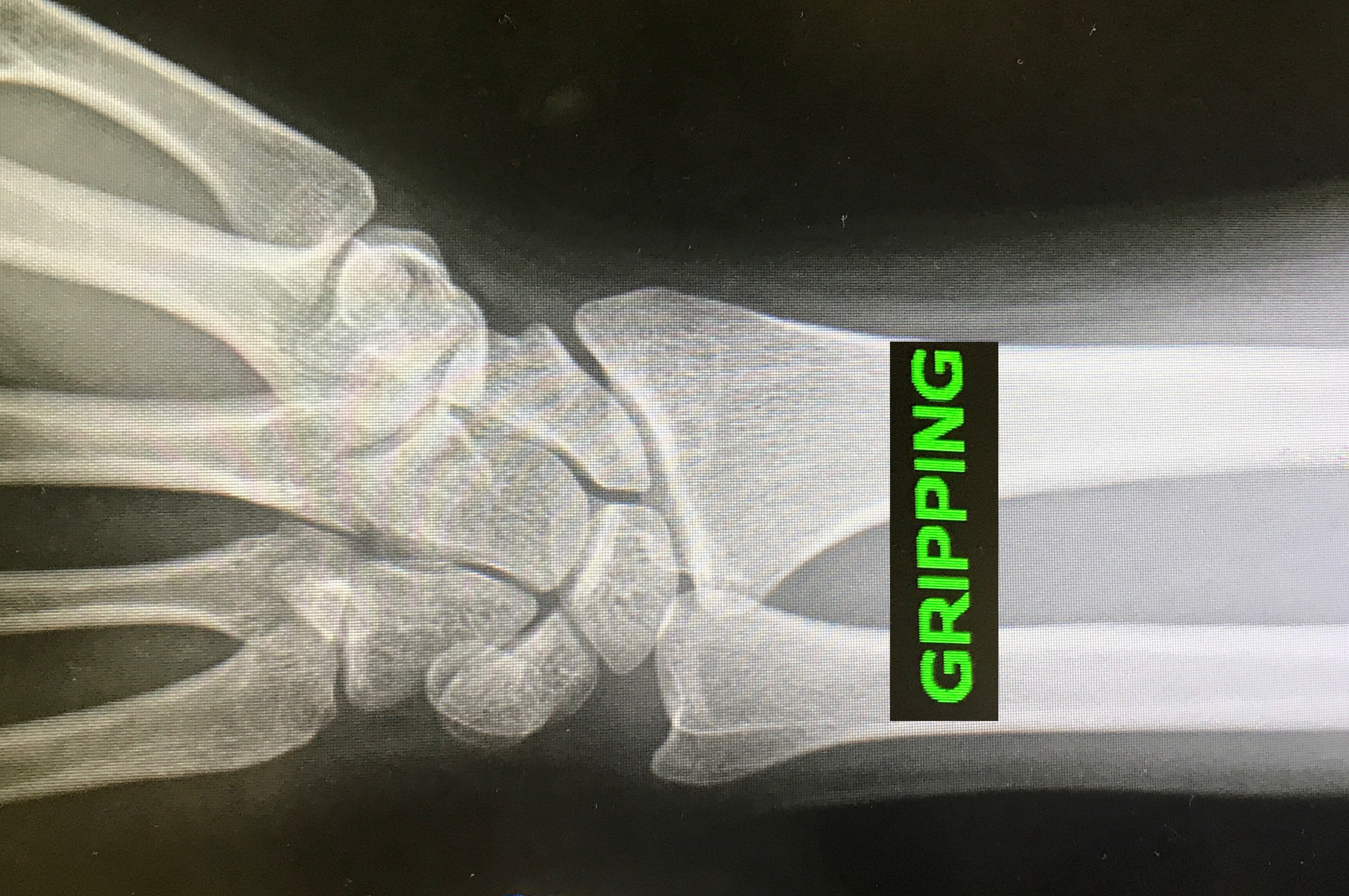 Gripping view done in neutral forearm rotation shows markedly worse positive ulnar variance.