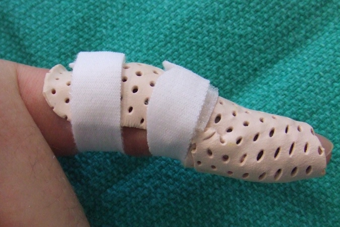 3 This orthosis design controls DIP position while preventing PIP hyperextension.  With strap loosening, the patient can exercise the PIP in flexion/extension while maintaining DIP hyperextension. (Contributed by Shrikant Chinchalkar MThO BScOT OTR CHT).