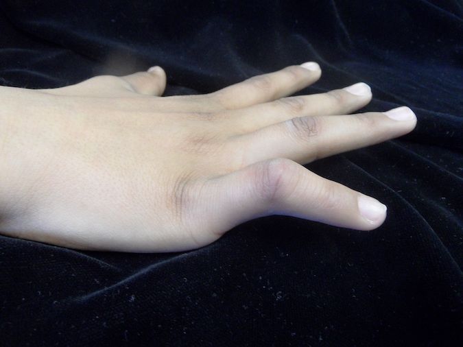 A relative motion orthosis (RMO) (Merritt) with MPj in flexion can treat extensor lag and facilitate restoration of complete PIP extension Image 4A and video 4B contributed by Karen S Schultz MS OTR CHT