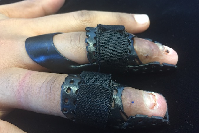 4B The same orthosis design with the critical DIP portion in place for the middle finger. (Contributed by Karen Schultz MS OTR CHT)