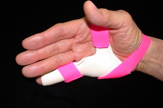 When a Zone IV injury occurs mid proximal phalanx, the injury could involve the central slip and lateral bands. Initial management for this type of injury, with lateral band  involvement requires an immobilization orthosis with the IPs in full extension. This  orthosis can be finger based or hand based.  A hand based orthosis will remain in place  better than a finger based one especially during night wear.Image 6 contributed by  Karen S Schultz MS OTR CHT